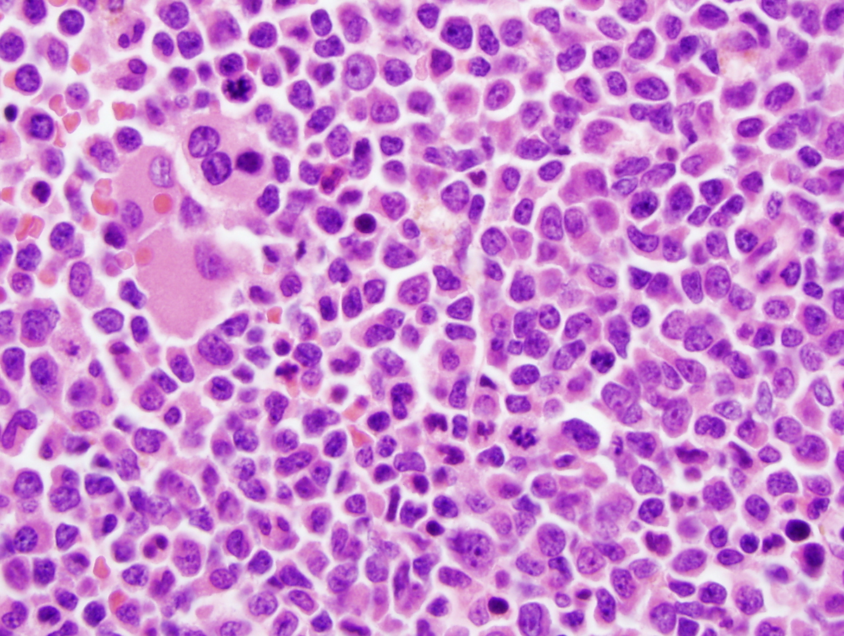 Clot section showing sheets of blasts and dysplastic megakaryocytes